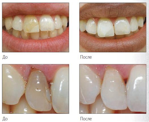 Внутриканальное отбеливание зубов: белизна изнутри