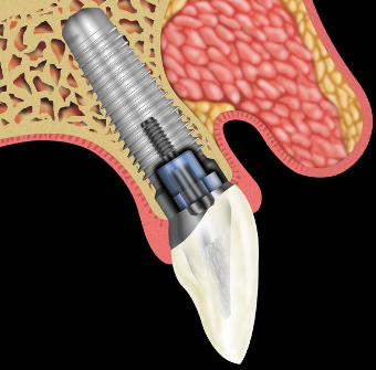 Чем больше имплантатов во рту, тем больше потеря кости