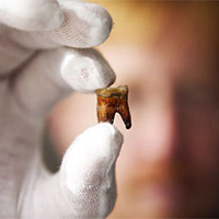 Удаление зубов – самое древнее направление в стоматологии