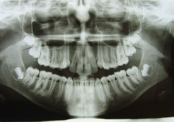 Аномалии развития зубов