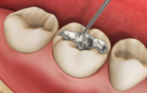 Как замаскировать пломбу из амальгамы