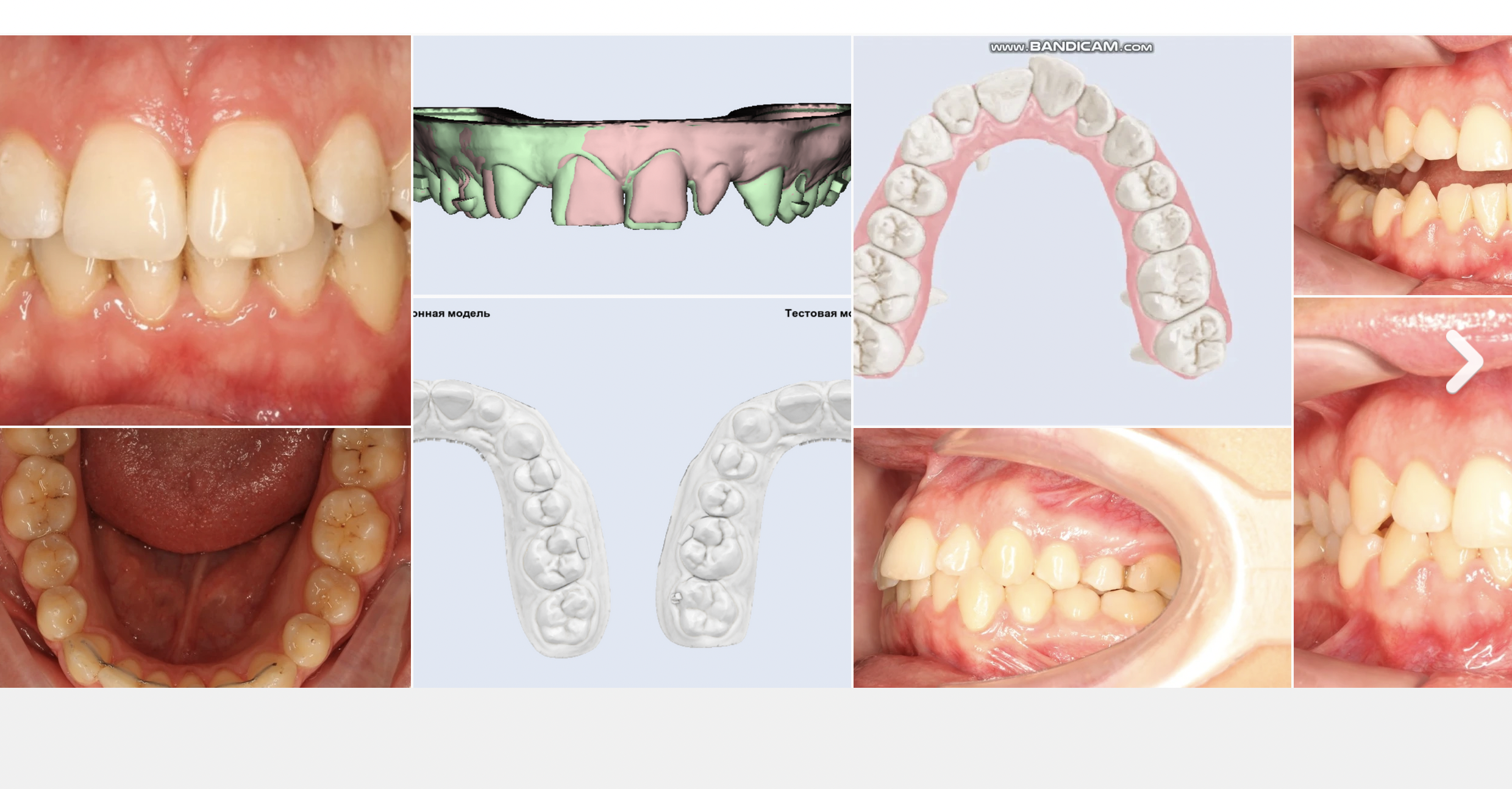 Элайнеры | Maestro 3D V6 в практике врача-ортодонта и зубного техника