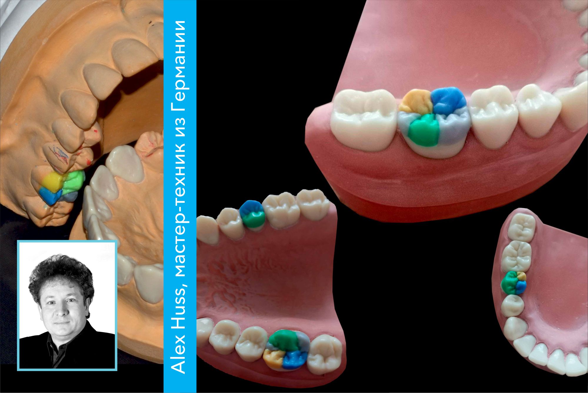 Практический курс! Анатомическое восковое моделирование окклюзионных поверхностей боковых зубов.