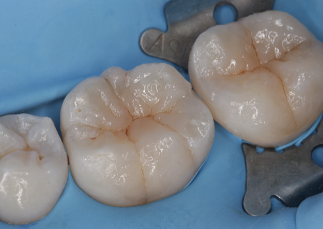 Прямая реставрация боковой группы зубов с нуля и до эстетики I и II класс