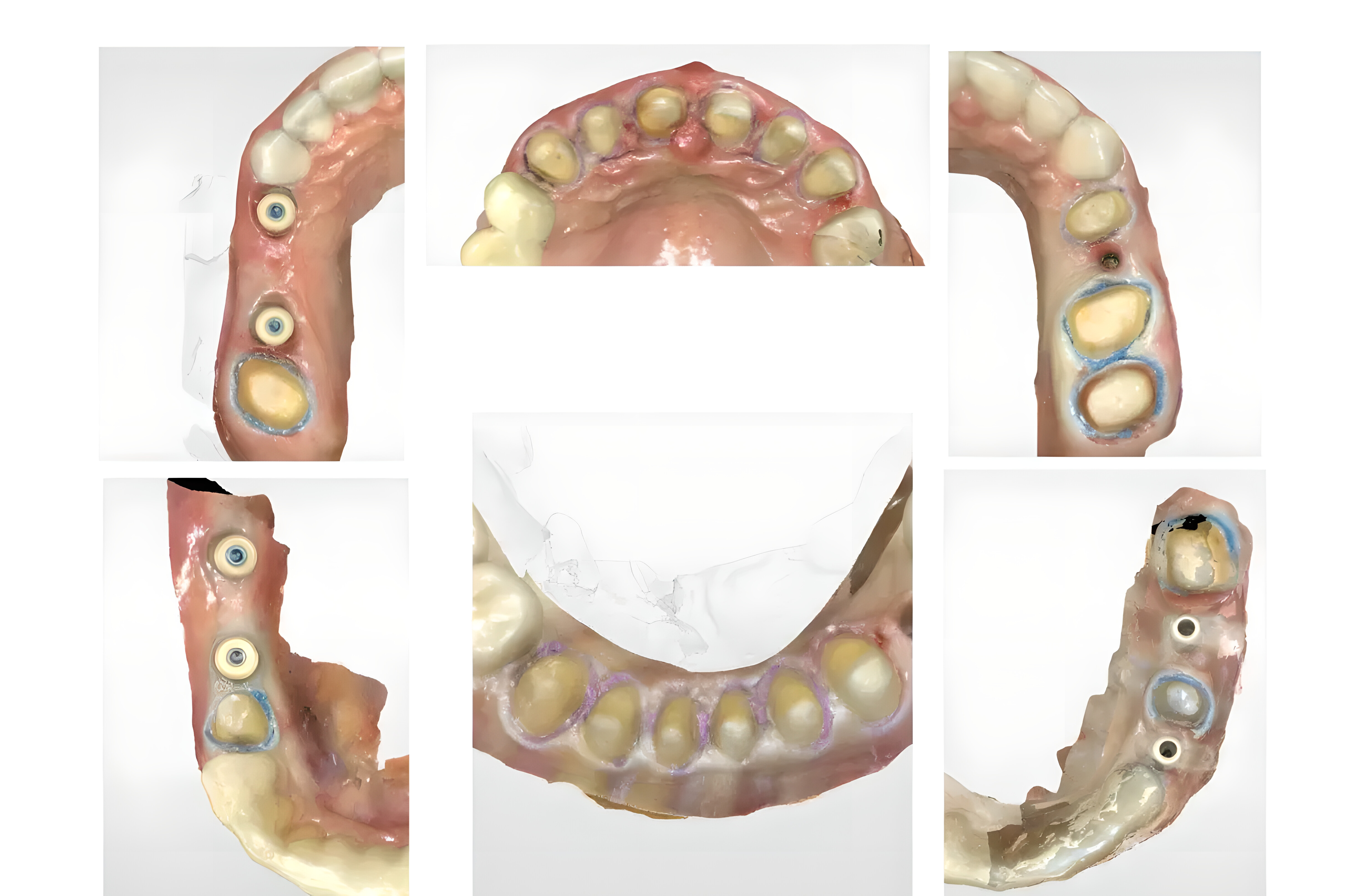 Цифровая стоматология и 3d-печать от А до Я. Клинический и лабораторный этапы