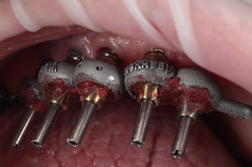 «Ошибки планирования при тотальном протезировании и пути их решения»