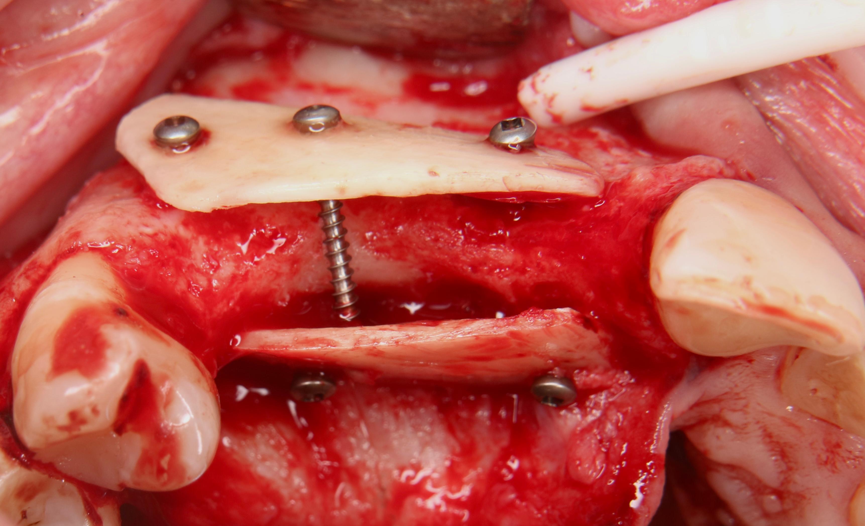 Протоколы аугментации костной и мягкой ткани в имплантологии с использованием аутотканей. Prof. Dr. F. Khoury: ламины и «костная морковка»