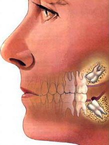 Перикоронит наблюдается в 60 – 80 % случаях прорезывания зубов мудрости 