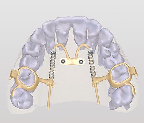 Цифровое планирование ортодонтических мини-имплантатов и моделирование аппаратов с кортикальной опорой  по концепции pin-first