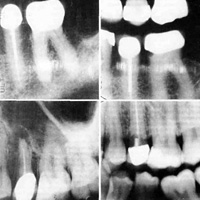 Рентгенологические исследования зубов