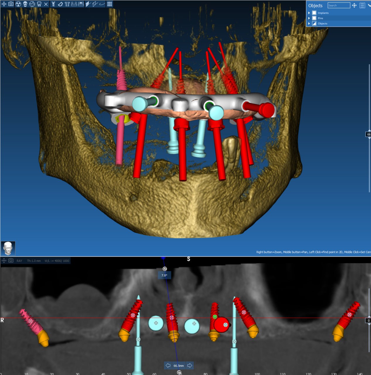 Темакурса:«РазборныехирургическиешаблонывRealGUIDE:поэтапноемоделированиенакостных,комбинированных,металлическихшаблоновиконструкцийдля