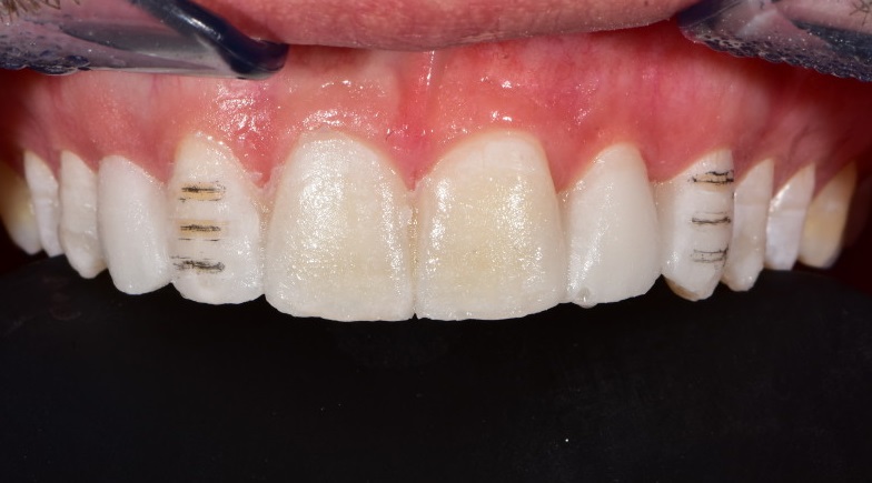 Преображение передних зубов различными видами реставрации