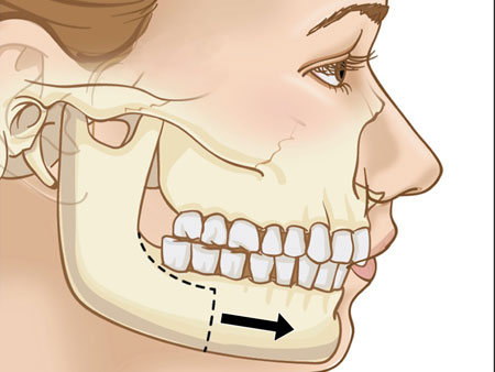 Деформации верхней и нижней челюсти