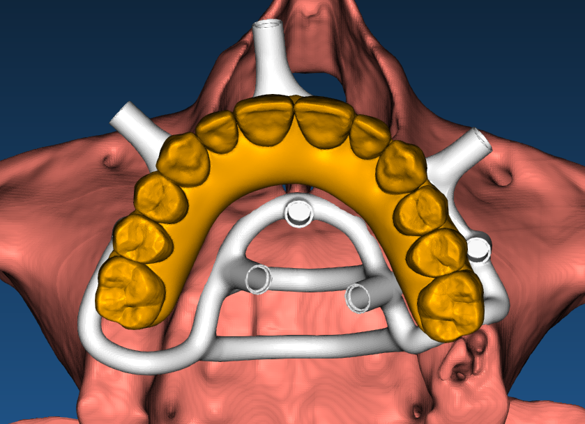 Тема курса: «Разборные хирургические шаблоны в RealGUIDE: поэтапное моделирование накостных, комбинированных, металлических шаблонов и конструкций для