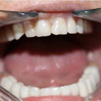 Исследование причин снятия несъемных зубных протезов