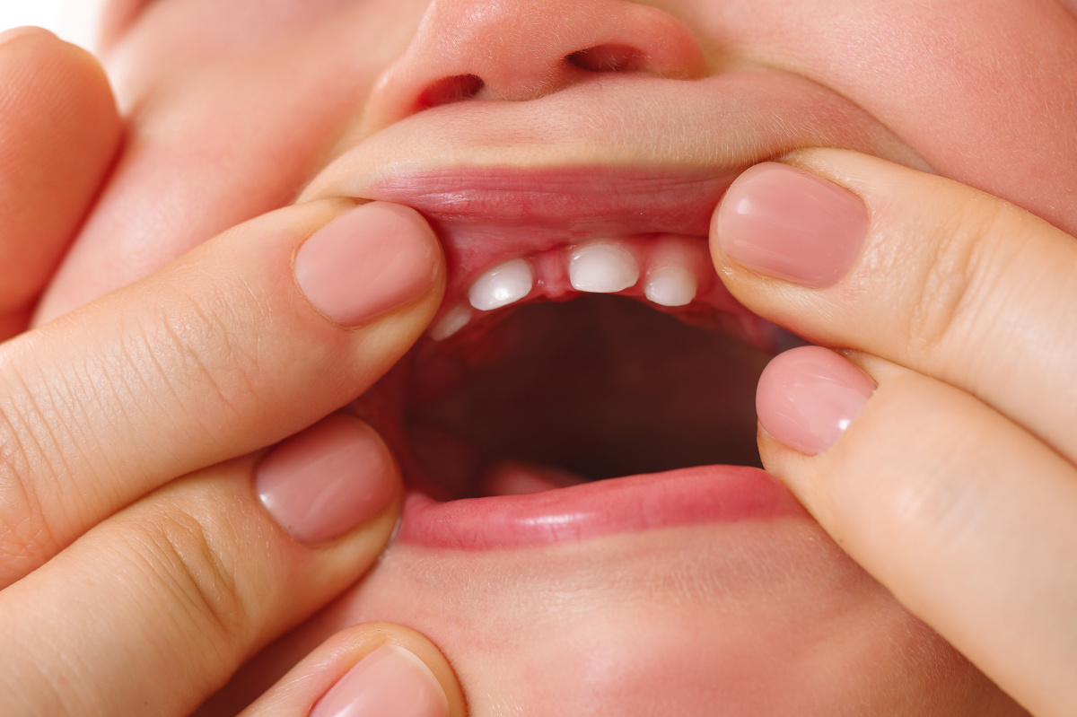 Молочные зубы (временный прикус)