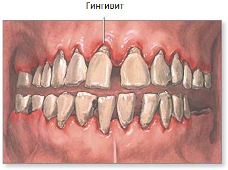 Гингивит - чем он опасен, и почему не стоит его недооценивать