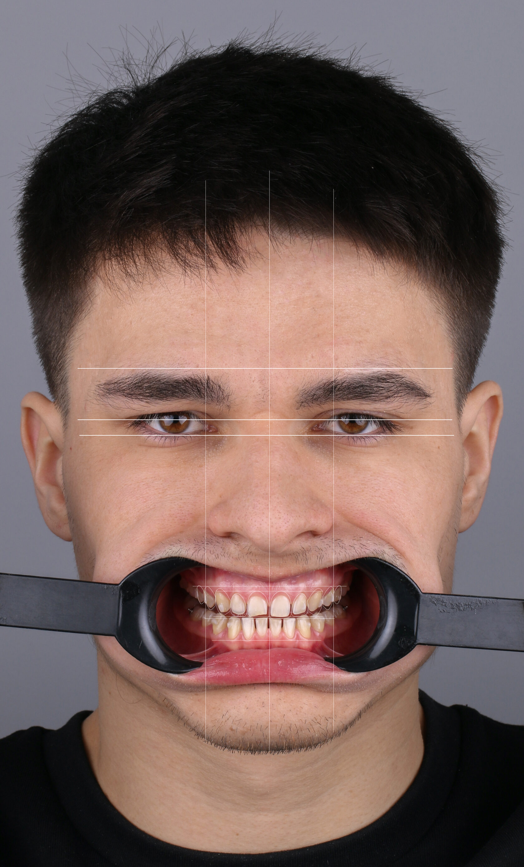 «Моделирование функции и эстетики в программе Exocad»