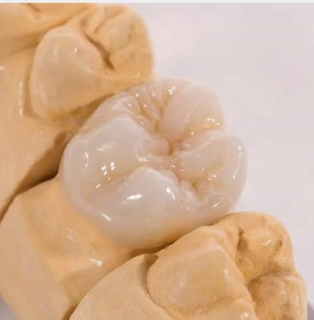 «Новые возможности прессованной керамики. Мостовидные протезы. Дисиликат лития упрочненный диоксидом циркония»