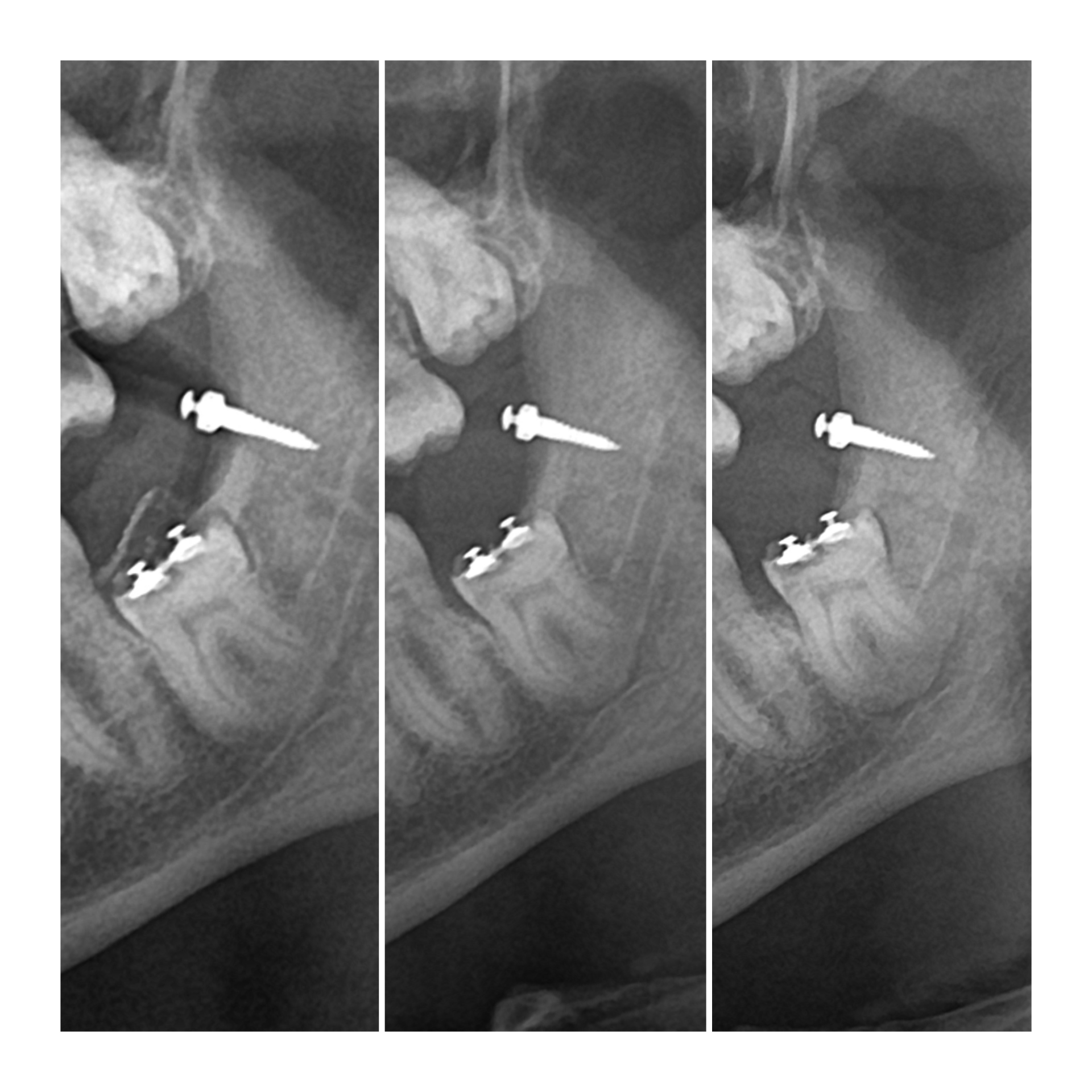 ОПТГ через 0 , 7 , 11 недель. Заметна динамика.