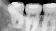 Аномалии корней зубов