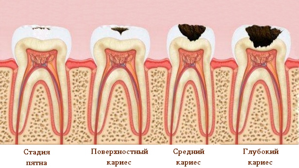 Кариес зубов средний