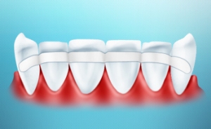 Шинирование зубов – что это за процедура и для чего она нужна?