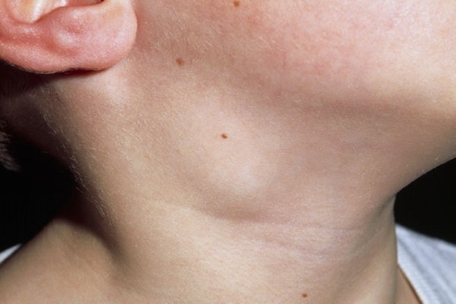 Воспалительные процессы челюстно-лицевой области у детей