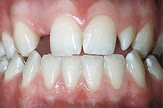 Аномалии развития зубов