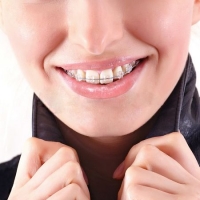 Сапфировая брекет-система: только украшение или действительно более эффективный способ выравнивания зубов?