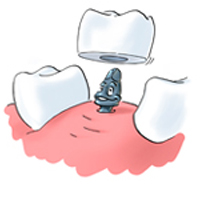 Классическое зубное протезирование или имплантация.