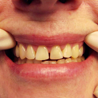 Дефекты зубных рядов: окклюзия и прикусы