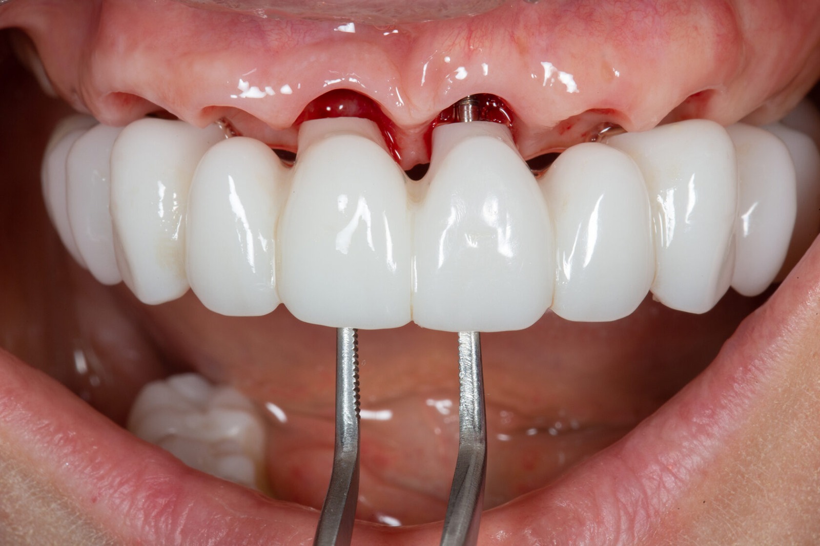 «Digital Full Arch - Moderate atrophy. Цифровые протоколы немедленной нагрузки с умеренной степенью атрофии»