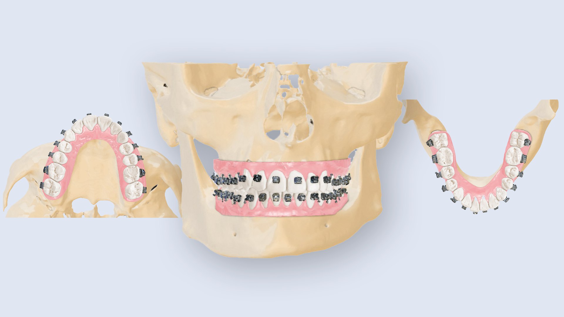 Непрямая фиксация брекетов