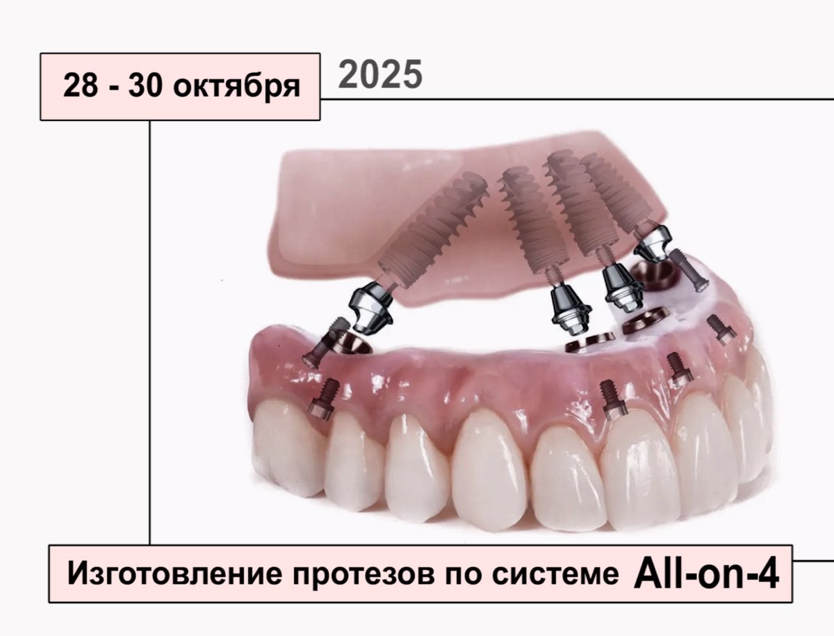 Концепция «All-on-four». Создание имплантационных протезов на винтовой фиксации для немедленной нагрузки.