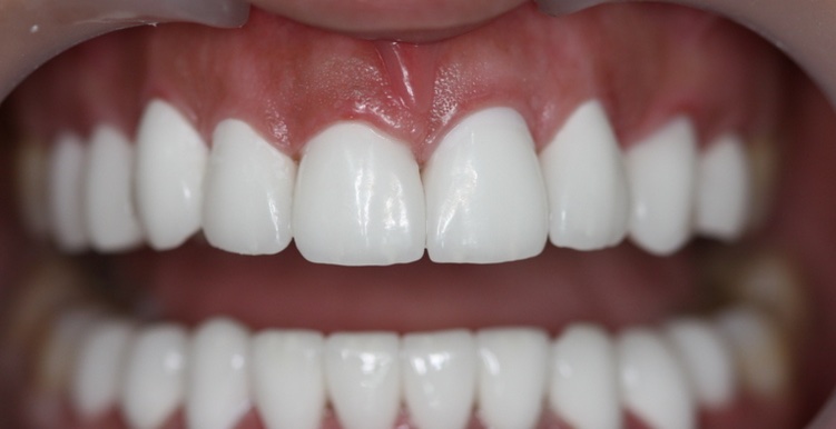 Виниры и люминиры - «моментальная ортодонтия»