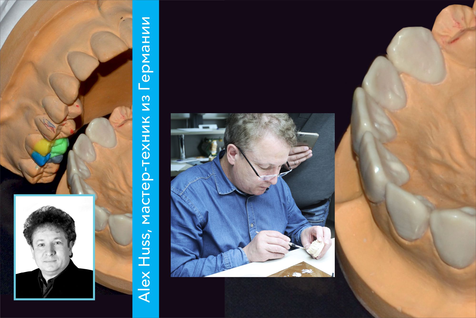 Воскование фронтального участка зубов с учетом фонетики, функции и эстетики