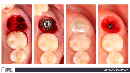 Одномоментная имплантация, немедленная нагрузка и формирование защитного барьера. Командный подход: хирург, ортопед, техник.