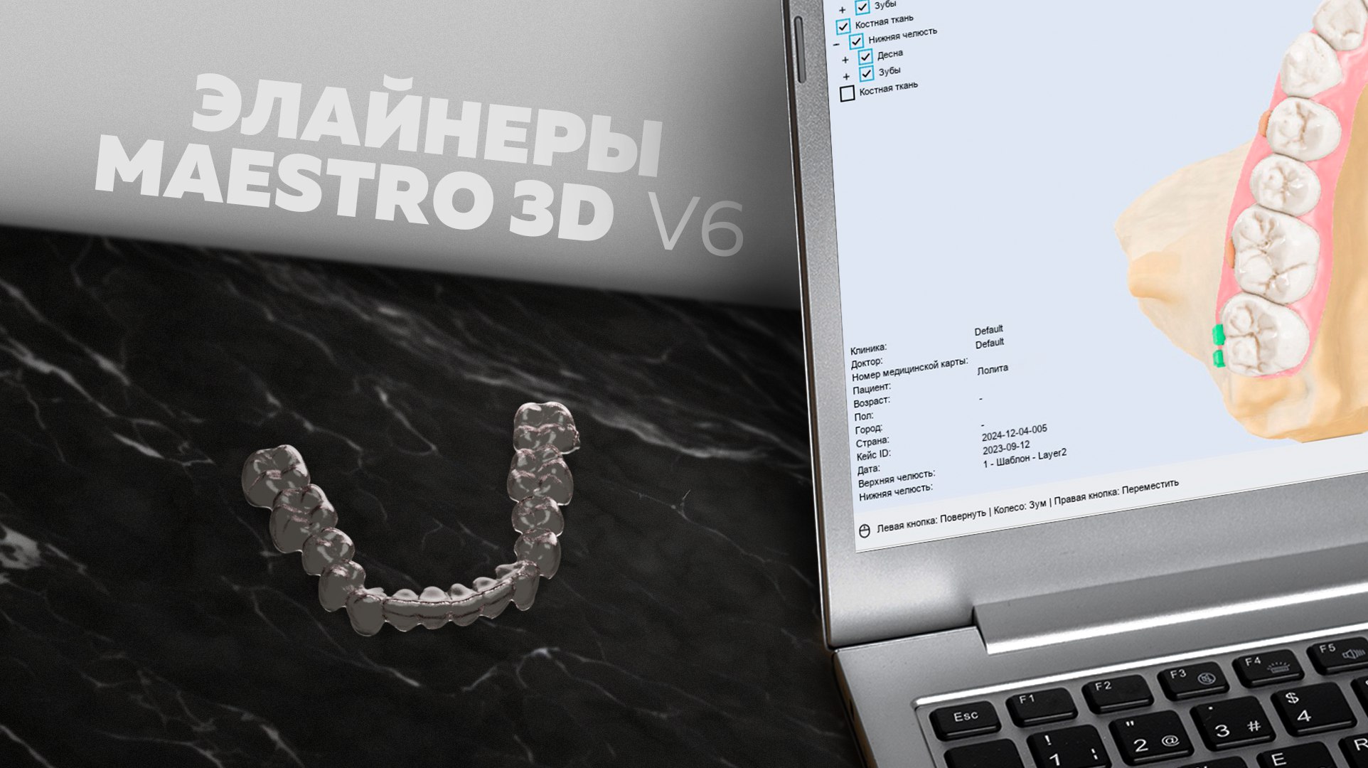Элайнеры | Maestro 3D V6 в практике врача-ортодонта и зубного техника