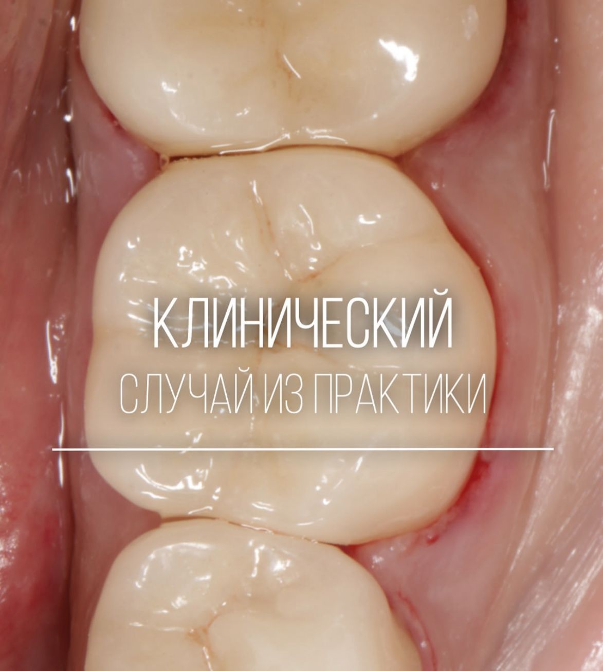 Инструментальная обработка корневых каналов