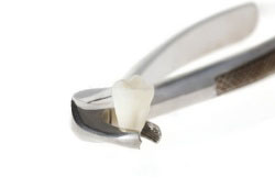 Противопоказания при удалении зубов