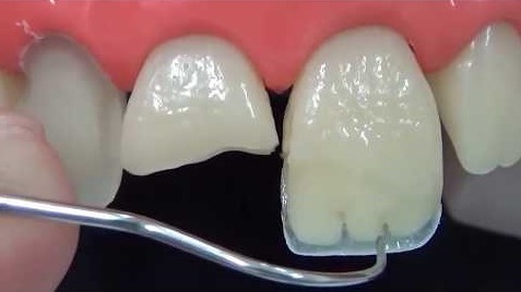Наращивание зубов: современные методы