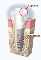 Дентальная имплантация зубов