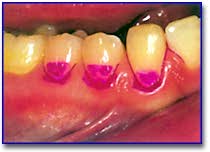 Виды современных средств местной профилактики стоматологических заболеваний. Часть II