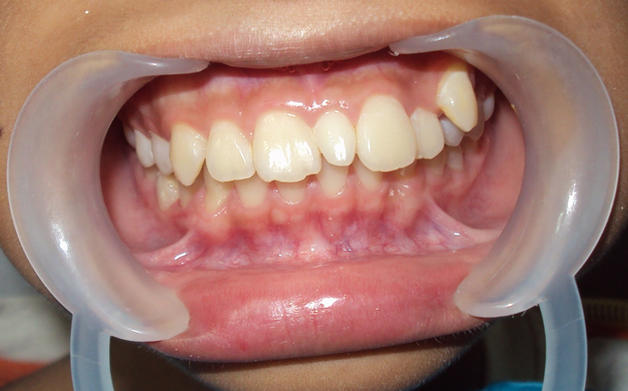 Гипердонтия (сверхкомплектные зубы)