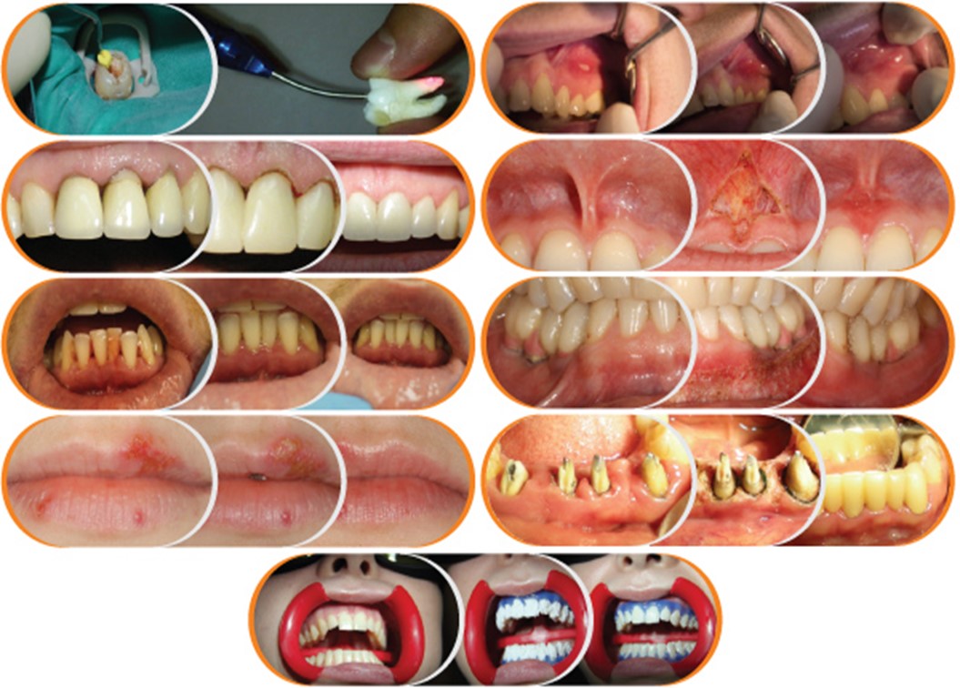 Лазерная стоматология. Вся информация о стоматологических диодных лазерах на клинических примерах.