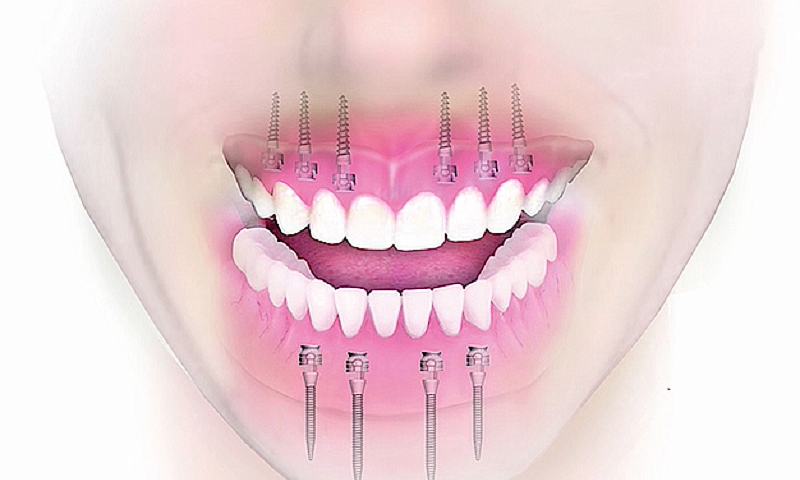 Концепция лечения пациента с полной потерей зубов. Часть 1