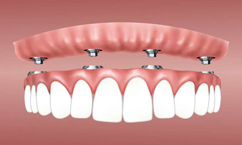 Концепция лечения пациента с полной потерей зубов. Часть 2