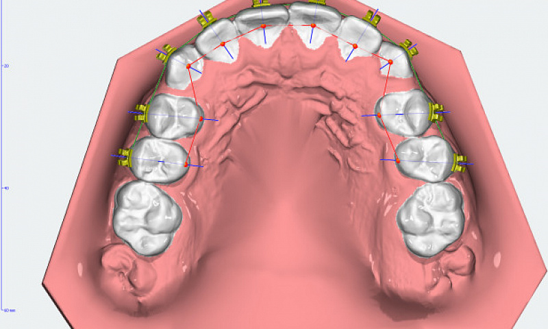 Виртуальная установка брекет - систем — будущее любой стоматологии?