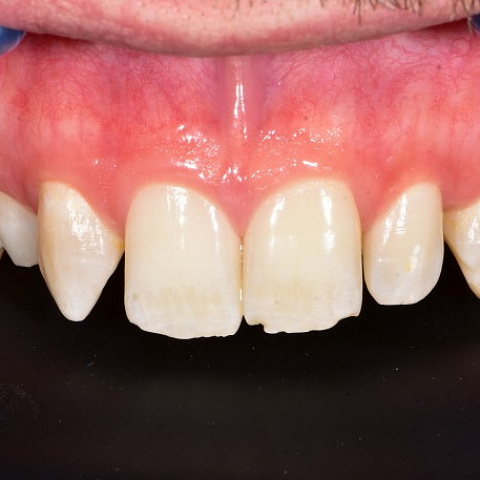 Преображение передних зубов различными видами реставрации